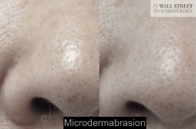 Microdermabasion