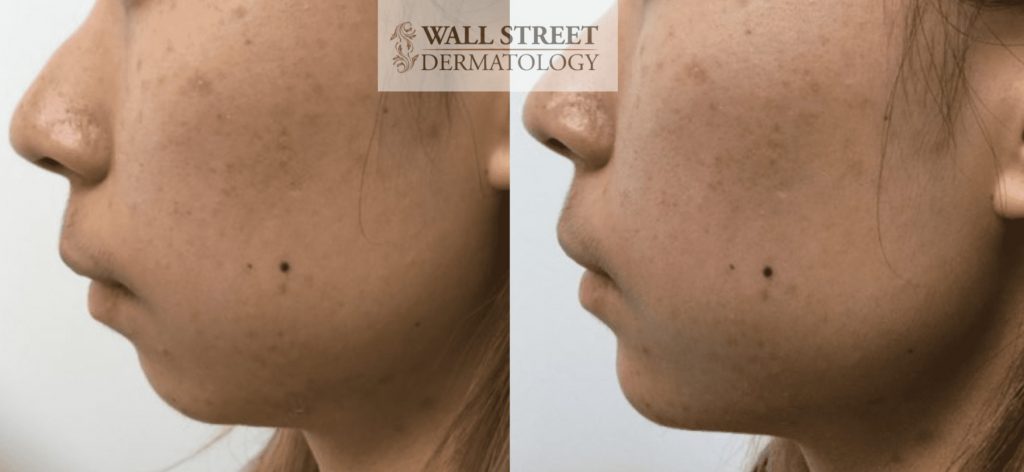 Injectable Fillers for Chin Augmentation