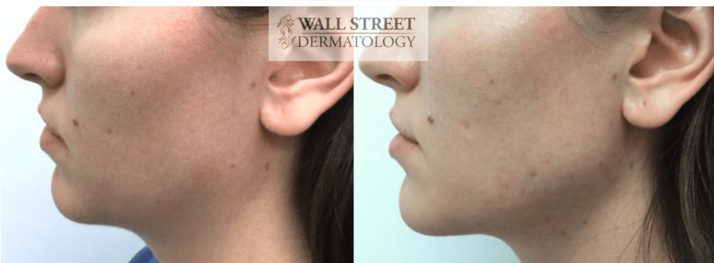 Injectable Fillers to Jawline