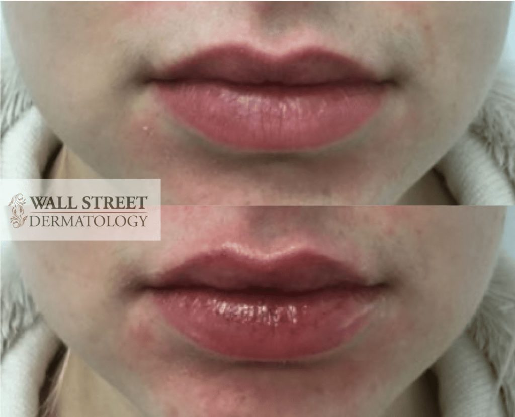 Injectable Fillers to Lips