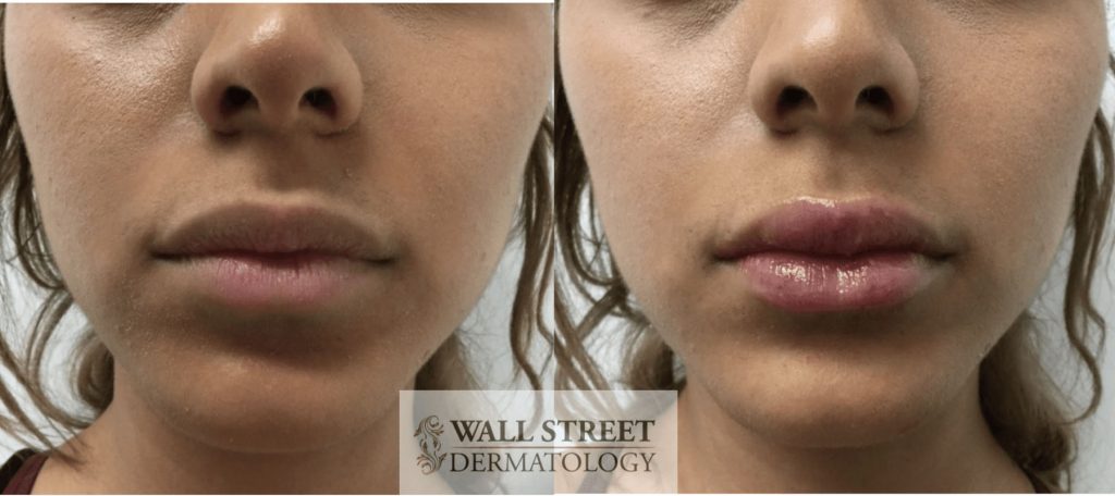 Injectable Fillers to Lips