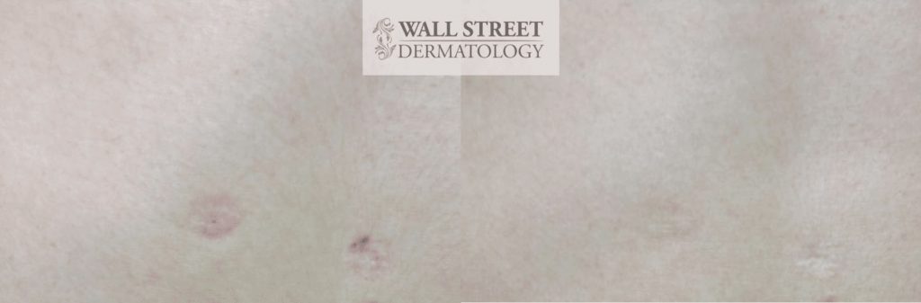Laser Scar Treatment Before and After