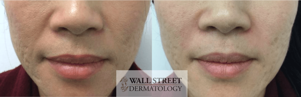 smile lines treatment