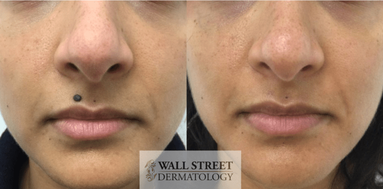 Does Mole Removal Leave A Scar Wall St Dermatology