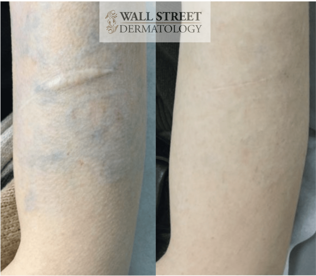 Surgical Scar Revision Before and After